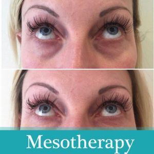 mesotherapy treatment before-after