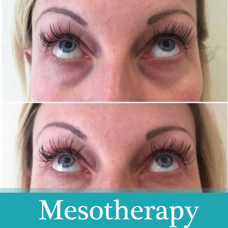 You are currently viewing Why is hyaluronic acid used in mesotherapy?