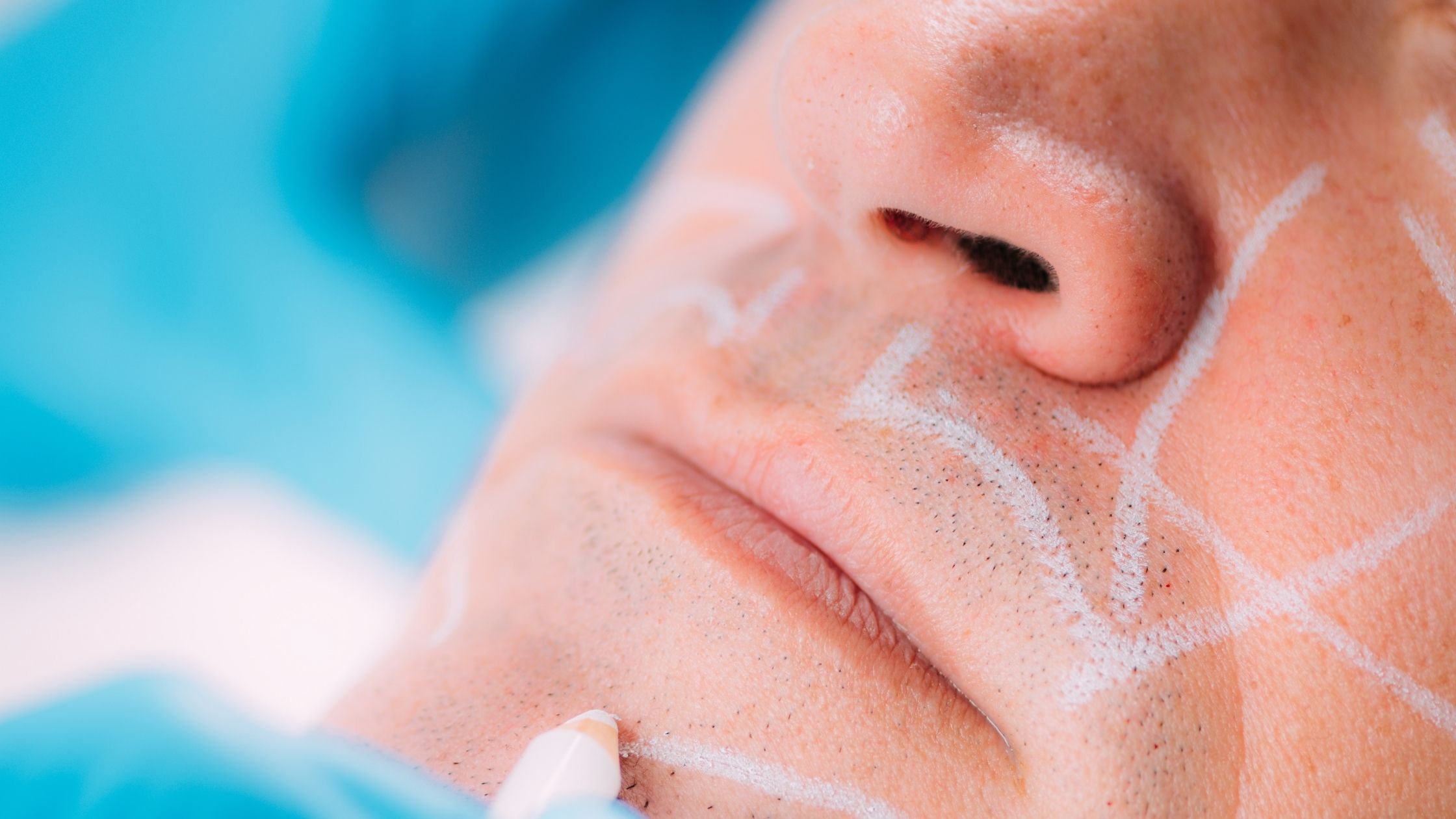 You are currently viewing What are dermal fillers? Benefits And effects
