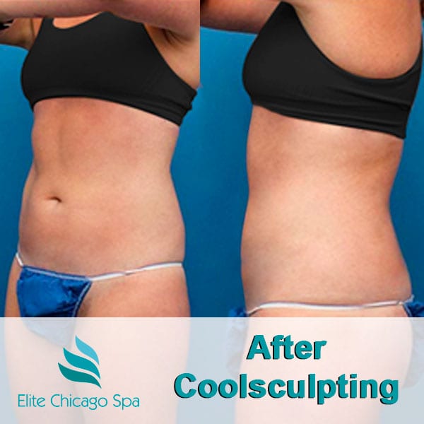 woman after coolsculpting
