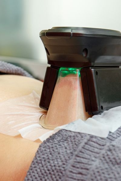 coolsculpting safe procedure for fat removal