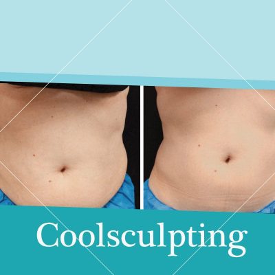 Get to know coolsculpting