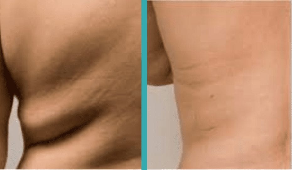 Before and after coolsculpting