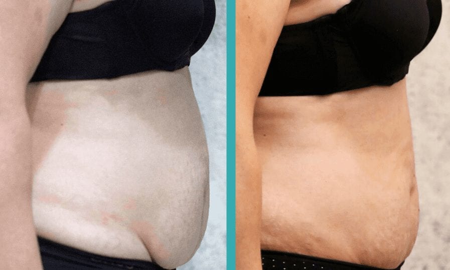 Coolsculpting abdomen before and after