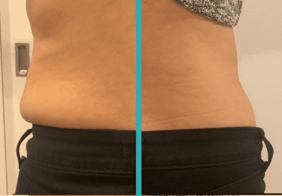 Coolsculpting in chicago before and after pic