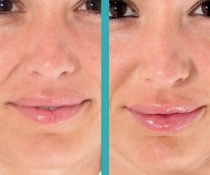 lip injections patient before and after