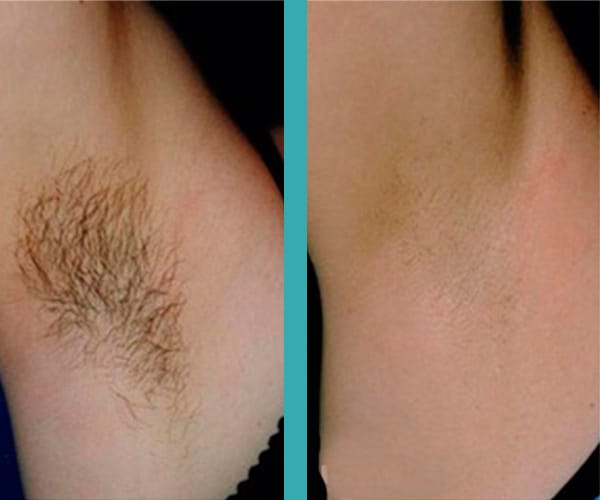 top laser hair removal