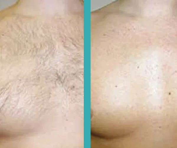 top laser hair removal