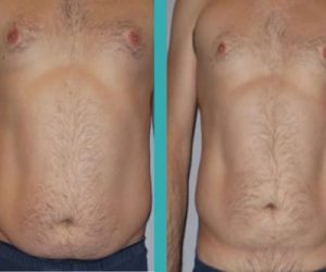 Coolsculpting for men-how to get rid of belly fat
