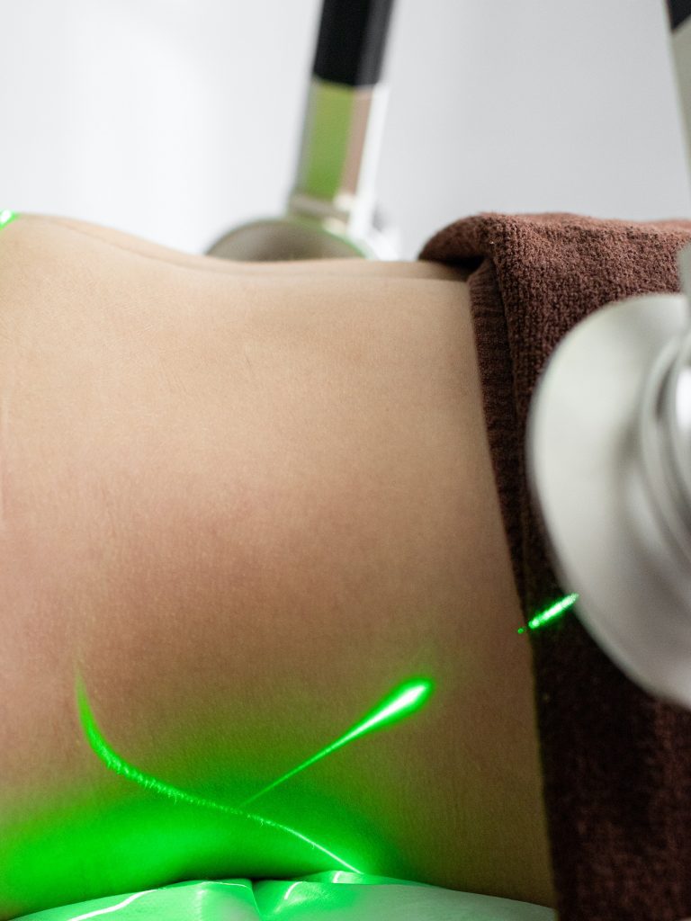 Laser fat removal