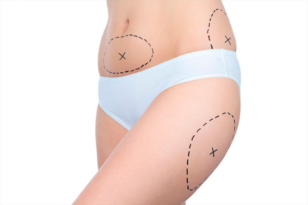 Unknown Laser Fat Removal Facts