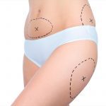 History and Evolution of Laser Liposuction