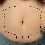 Why Not to Have a Traditional Liposuction