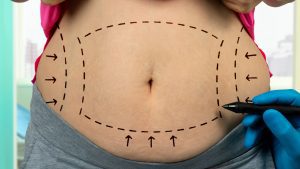 Read more about the article Why Not to Have a Traditional Liposuction