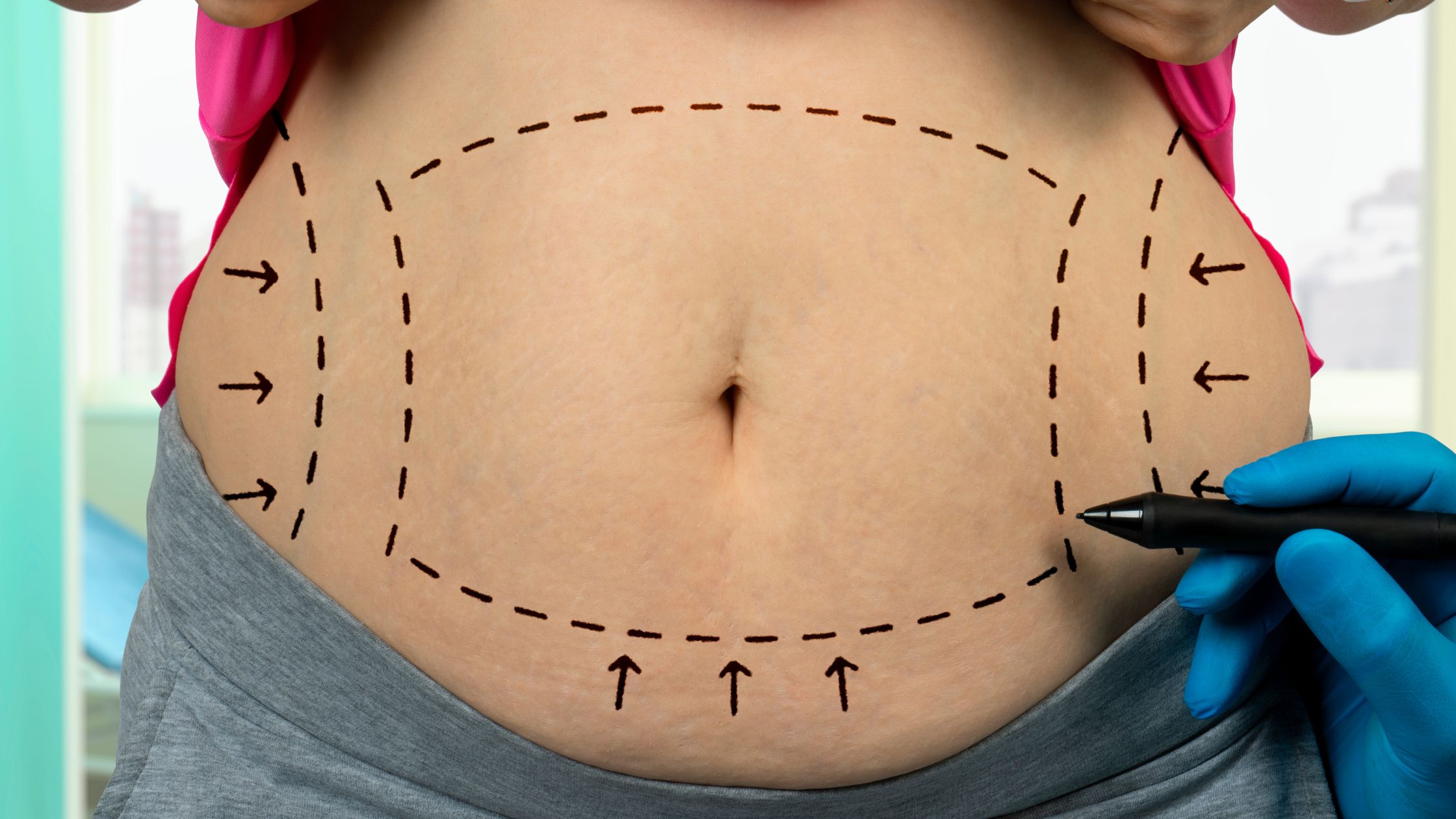 You are currently viewing Why Not to Have a Traditional Liposuction