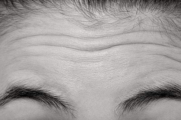 forehead for dermaplaaning