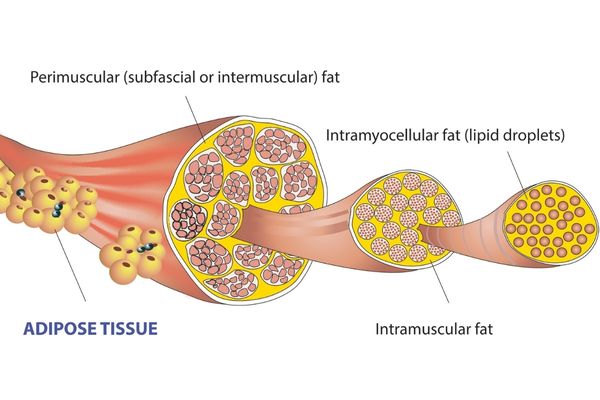 intermuscular fat from types of body fat