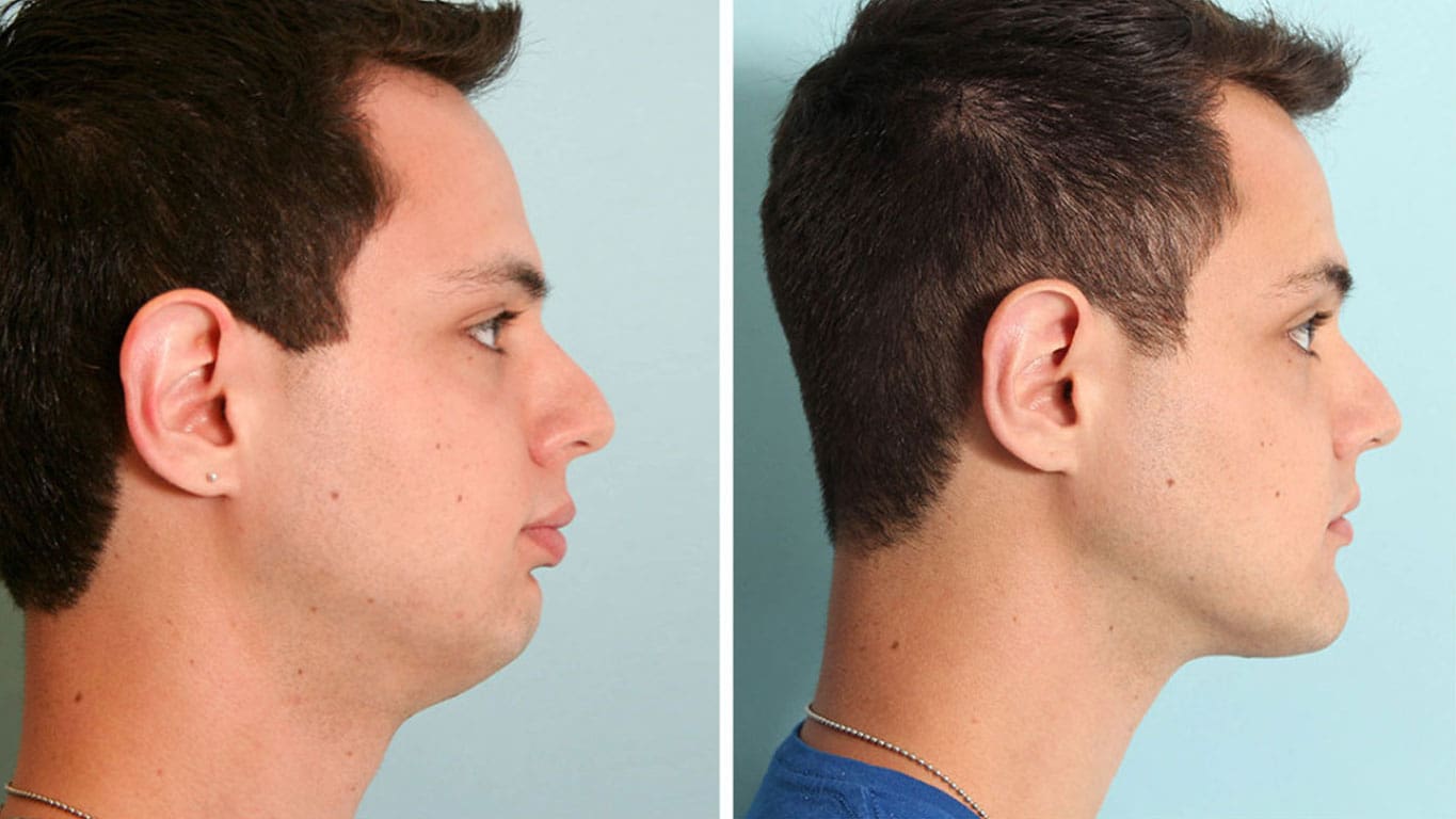 Chin reduction in Chicago