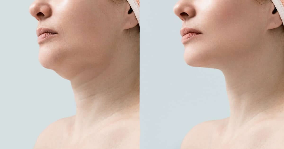 Chin reduction in Chicago