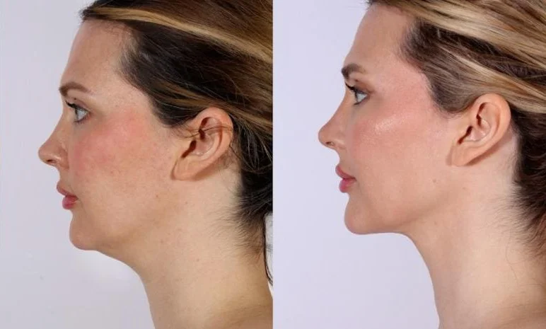Chin reduction in Chicago