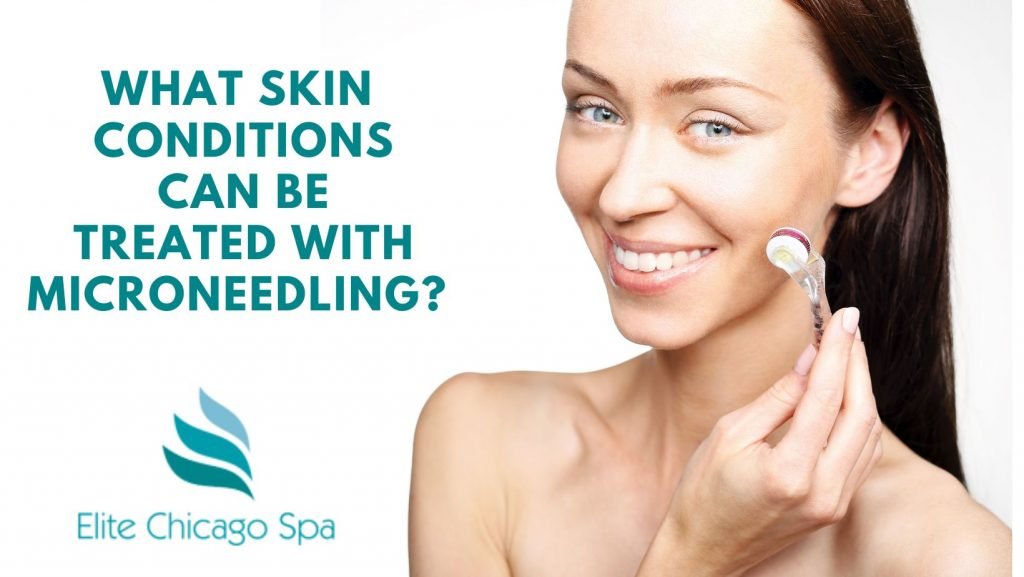 What Skin Conditions Can Be Treated With Microneedling