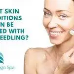 What Skin Conditions Can Be Treated With Microneedling?