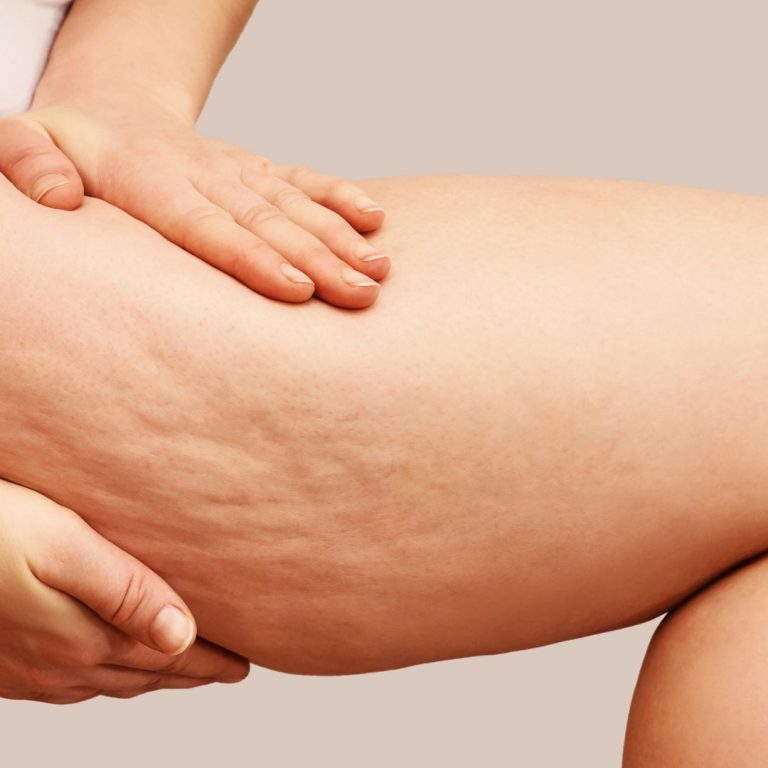 Cellulite Removal Chicago Illinois