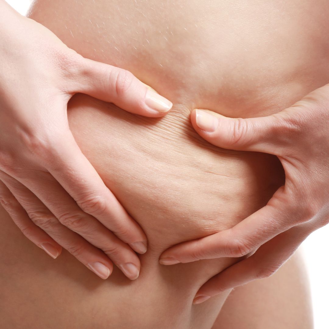 Chicago cellulite removal