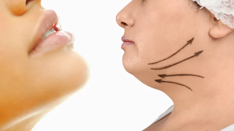 What to expect with double chin reduction treatment