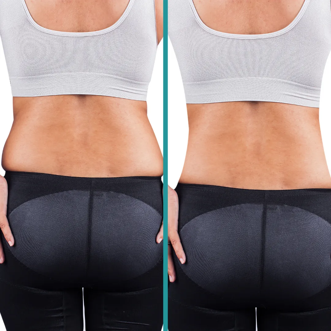 CoolSculpting fat reduction results per session