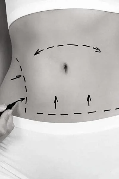 Liposonix Chicago Illinois