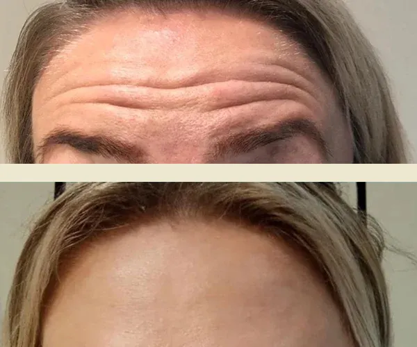 Before After Results
