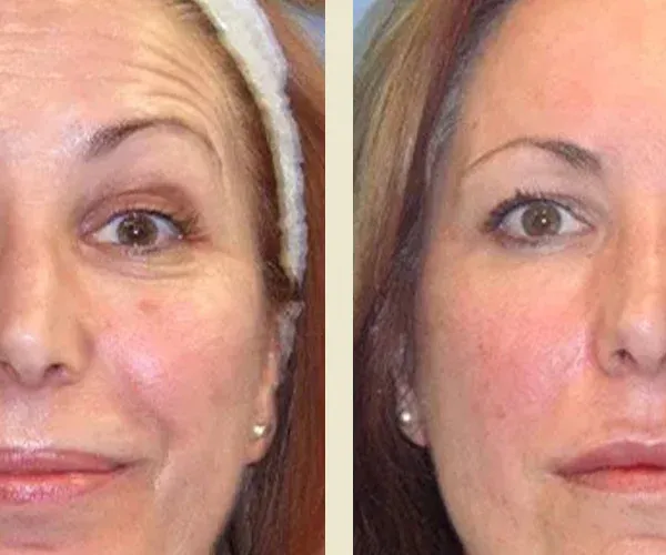 Before After Results