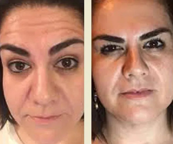 Before After Results
