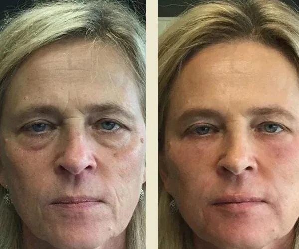 Before After Results