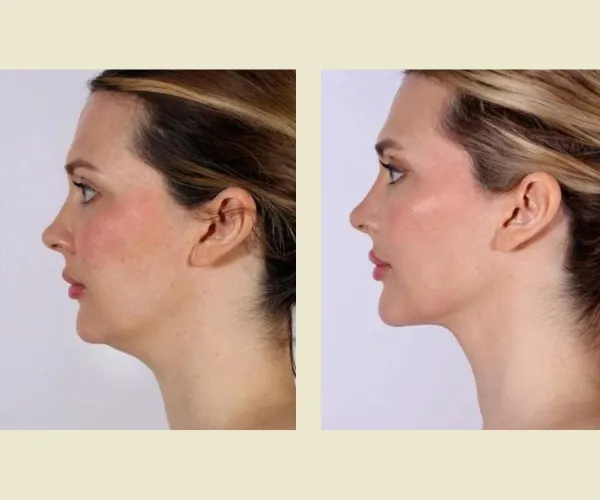 Before After Results
