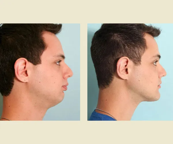 Before After Results