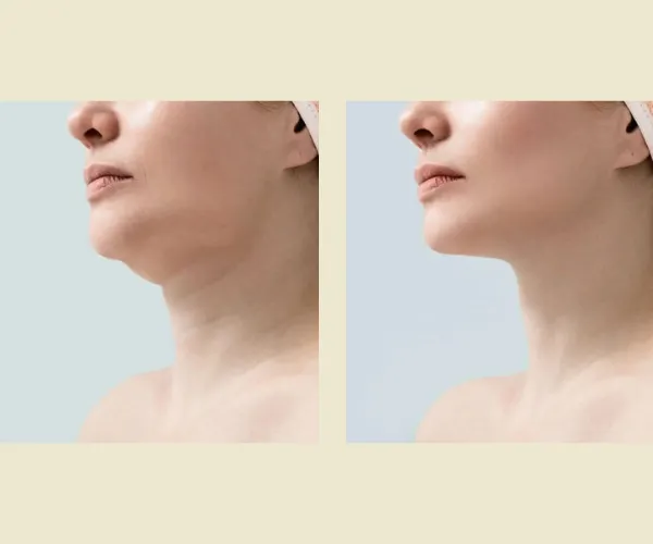 Before After Results