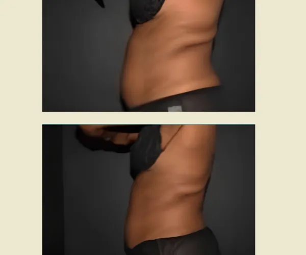 Before After Results