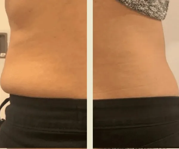 Before After Results