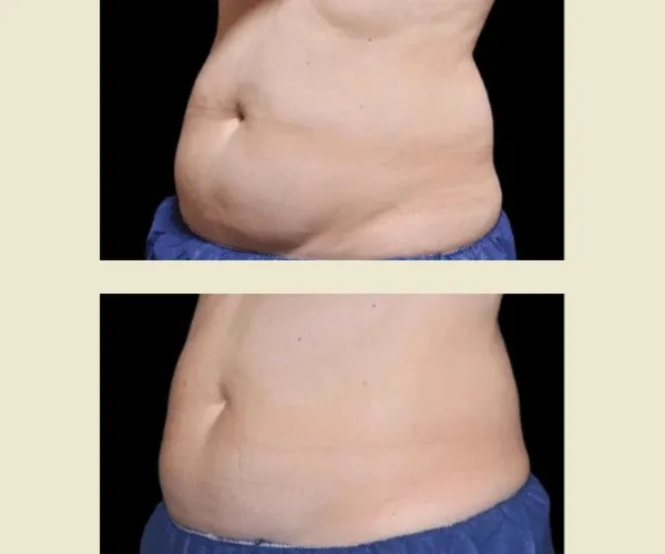 Before After Results