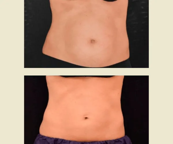 Before After Results