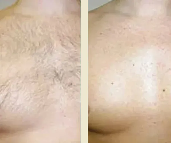 Before After Results