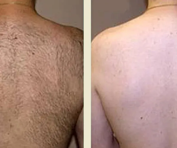 Before After Results