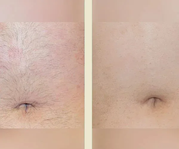 Before After Results
