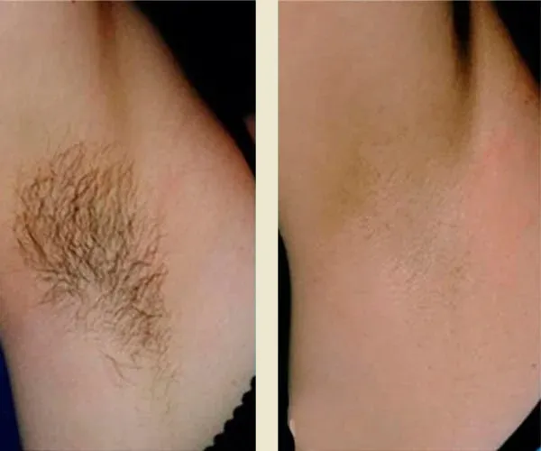Before After Results
