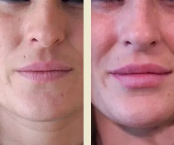 Before After Results