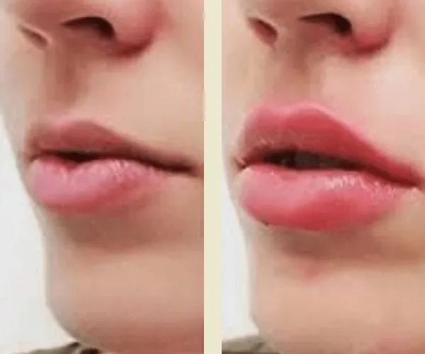 Before After Results