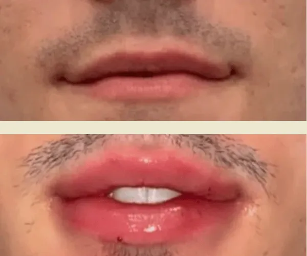 Before After Results