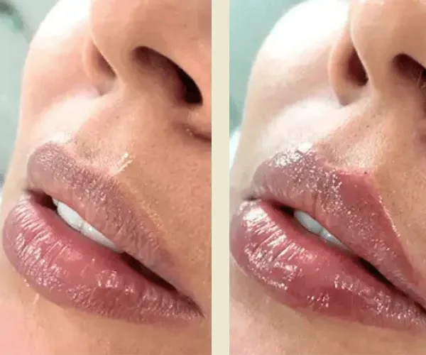 Before After Results